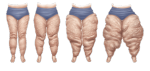 Lip&oelig;d&egrave;me des jambes