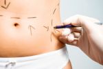 Coolsculpting, destruction des cellules graisseuses par le froid.